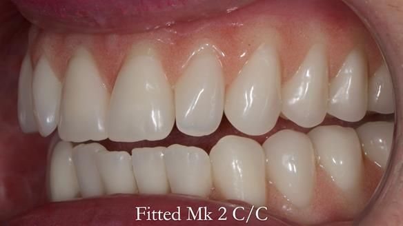 Replacing Madeline’s Complete denture FULL PROTOCOL