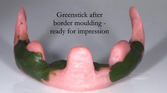 Replacing Madeline’s Complete denture FULL PROTOCOL