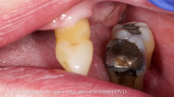 Finlay's Newsletter 59 Ultra hard partial dentures made for Gill