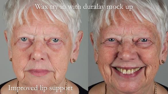 Finlay's Newsletter 59 Ultra hard partial dentures made for Gill