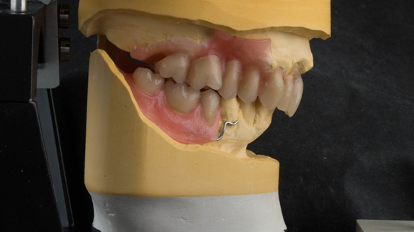 Figure 28 The remaining teeth to be extracted removed from casts with artificial teeth arranged to pre-drifted positions