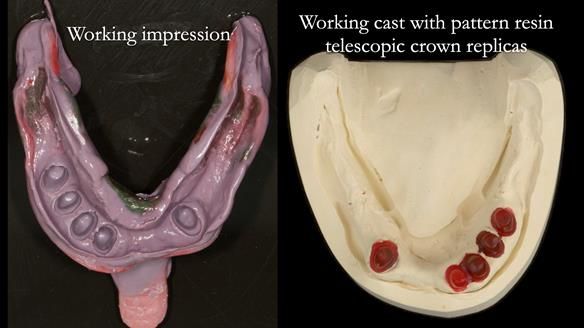 Newsletter 76: Jackie’s case – Telescopic overdenture & precision RPD (the tricky truth!)