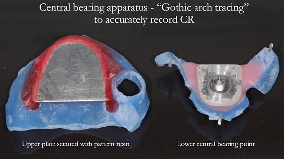 Finlay's Newsletter 58 Gasket upper partial denture for Zoe