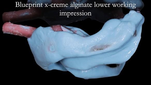 Newsletter 52 Managing Jo’s failing dentition with extractions and Mk 1/Mk 2 complete upper dentures and lower partial dentures FULL PROTOCOL