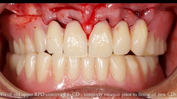 Finlay's Newsletter 62 provision of extractions and metal based complete dentures for Rafique