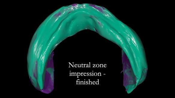 Newsletter 83: Sheila’s Complete Denture Success