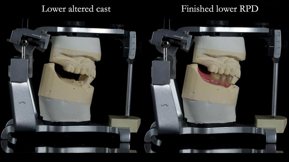 Newsletter 87 – Father Peter: A Partial Denture that needed Minor Miracle