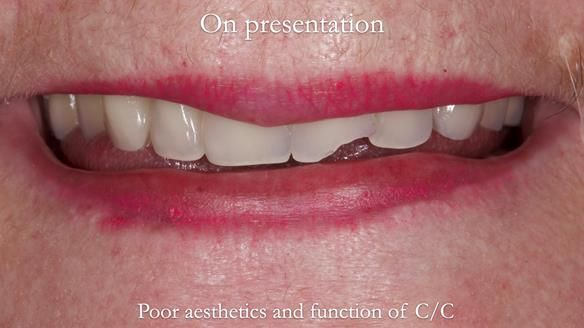 Replacing Madeline’s Complete denture FULL PROTOCOL