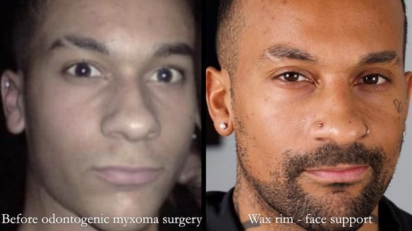 Upper metal base partial denture/occlusal stabilisation splint/obturator - full protocol