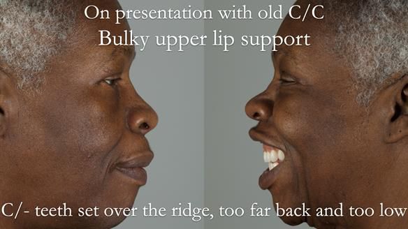 Newsletter 53 showing the making and fitting of ultra life-like dentures for Valena