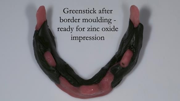 Managing poor implant positioning with complete dentures and Locator attachments - full protocol Newsletter 41