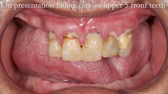 Finlay's Newsletter 62 provision of extractions and metal based complete dentures for Rafique