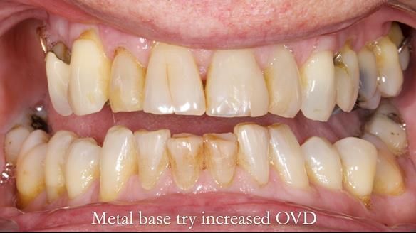 Finlay's Newsletter 64 case study - provision of a Kennedy class 2 metal based Scandinavian RPD for Ian
