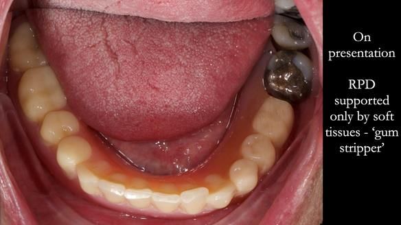 Finlay's Newsletter 59 Ultra hard partial dentures made for Gill