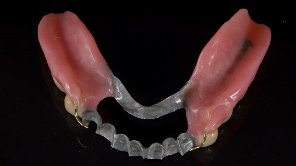 Newsletter 87 – Father Peter: A Partial Denture that needed Minor Miracle