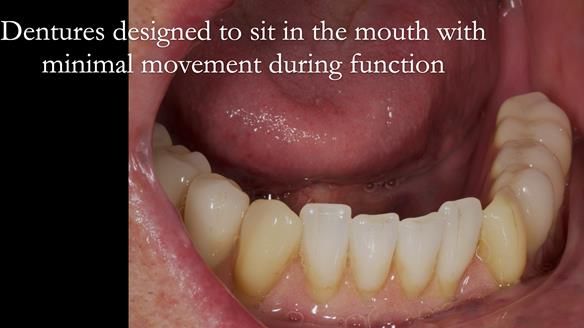 Newsletter 50 Special edition Complete Dentures FULL PROTOCOL