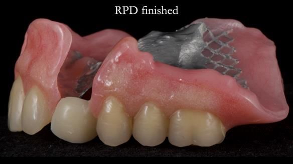 Newsletter 55 Provision of metal based partial dentures for Zephyrine with a repaired cleft lip and palate