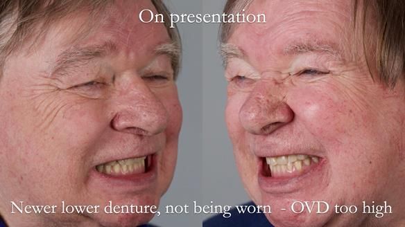 Newsletter 44 - extreme removable prosthodontics – engineering a super-strong and ultra-thin over denture