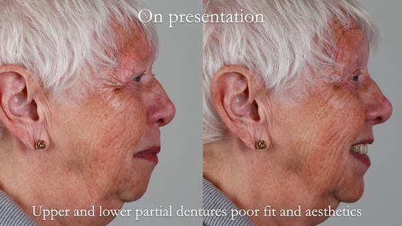 Finlay's Newsletter 59 Ultra hard partial dentures made for Gill