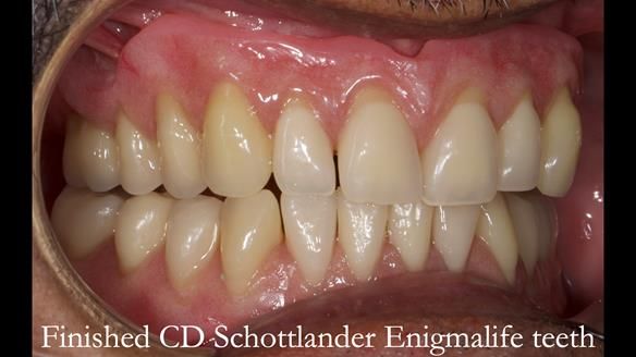 Finlay's Newsletter 62 provision of extractions and metal based complete dentures for Rafique