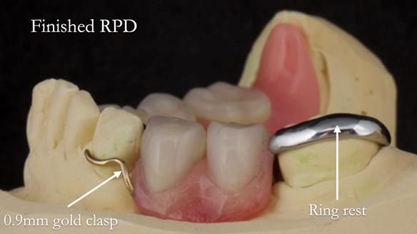 Eileen's transformation with upper and lower RPDs of Scandinavian hygienic design FULL PROTOCOL
