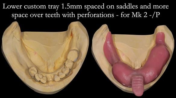 Newsletter 54 case presentation upper complete denture and lower Scandinavian designed hygienic partial denture for David