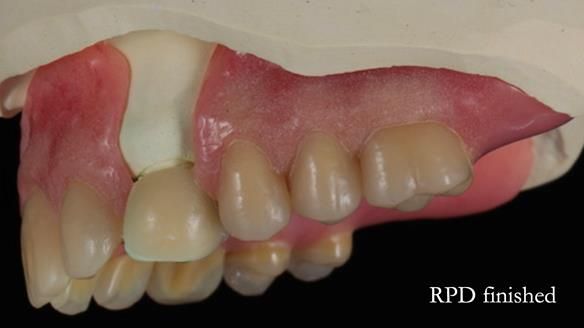 Newsletter 55 Provision of metal based partial dentures for Zephyrine with a repaired cleft lip and palate