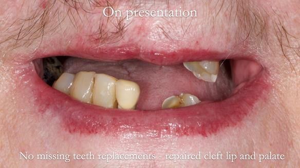 Newsletter 55 Provision of metal based partial dentures for Zephyrine with a repaired cleft lip and palate