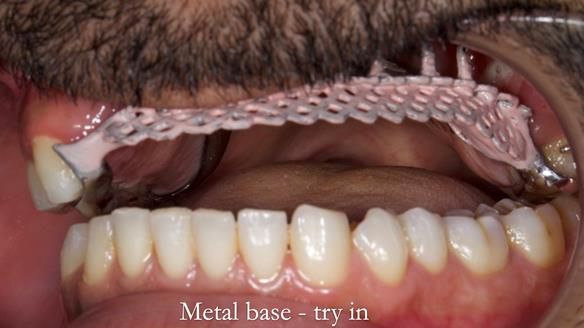 Upper metal base partial denture/occlusal stabilisation splint/obturator - full protocol