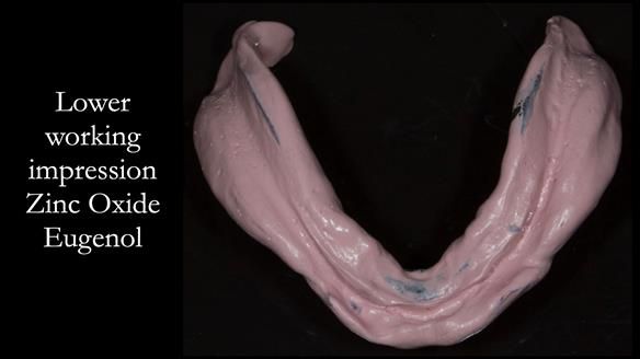 Newsletter 75: Marion’s case - Step-by-step complete denture workflow