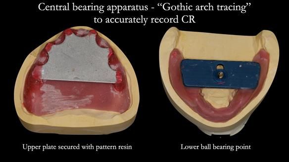 Managing poor implant positioning with complete dentures and Locator attachments - full protocol Newsletter 41