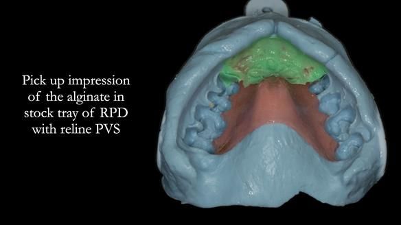 Finlay's Newsletter 63 Case study provision of metal based Scandinavian RPD - functional 10 years on