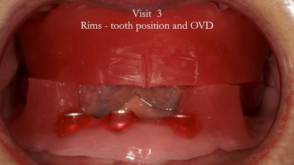Visit 3 registration stage - prescribing the position of the upper teeth and the correct occlusal vertical dimension