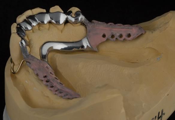 Figure 96 Mandibular cobalt chromium based framework (Chris Hesketh) - opaqued saddles - Scandinavian hygienic design with 0.9 mm wrought gold clasps on LR4 and LL3