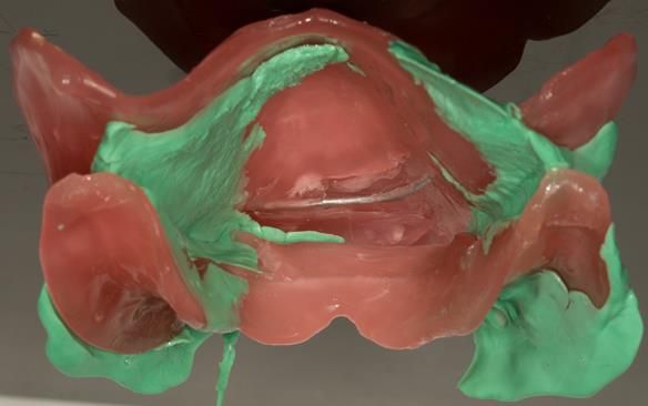 Figure 80 Primary registration rims used to record the APPROXIMATE centric relation (CR) and occlusal vertical dimension (OVD) to enable mounting of the definitive casts to fabricate the central bearing apparatus plates parallel to each other. Important s