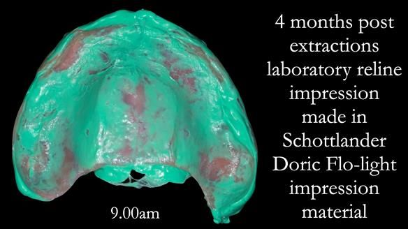 Newsletter 52 Managing Jo’s failing dentition with extractions and Mk 1/Mk 2 complete upper dentures and lower partial dentures FULL PROTOCOL