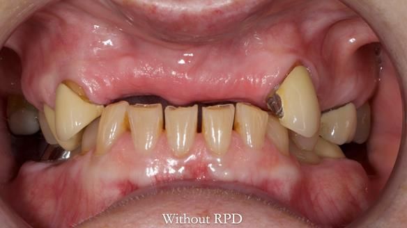 Newsletter 81 - Pam’s Story — how a partial denture changed her life (+ live walkthrough this Thursday)