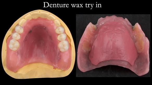 Newsletter 76: Jackie’s case – Telescopic overdenture & precision RPD (the tricky truth!)