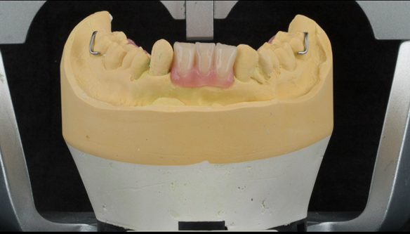 Figure 22 Lower Mk 1 immediate denture with 3 incisors instead of 4 for improved appearance. Figure 23 Finished upper and lower immediate dentures. Schottlander Enigmalife teeth
