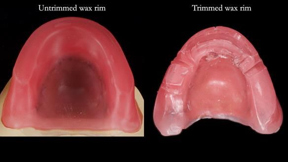 Newsletter 82 Mary - A complete upper and a one-tooth gasket denture