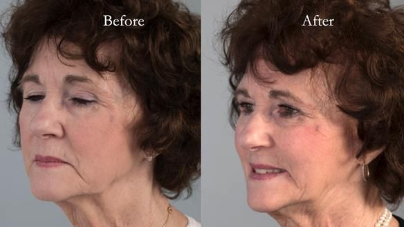 Newsletter 75: Marion’s case - Step-by-step complete denture workflow