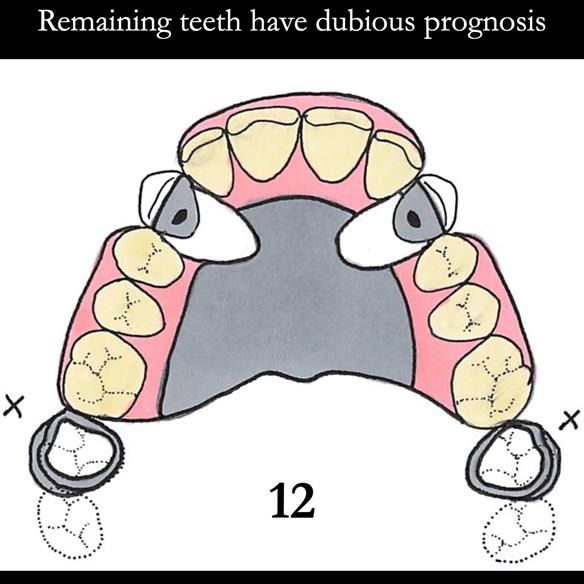 Universal Scandinavian partial denture designs