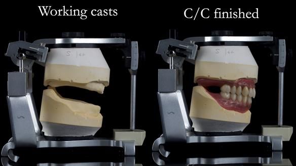 Newsletter 53 showing the making and fitting of ultra life-like dentures for Valena