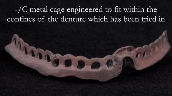Managing poor implant positioning with complete dentures and Locator attachments - full protocol Newsletter 41