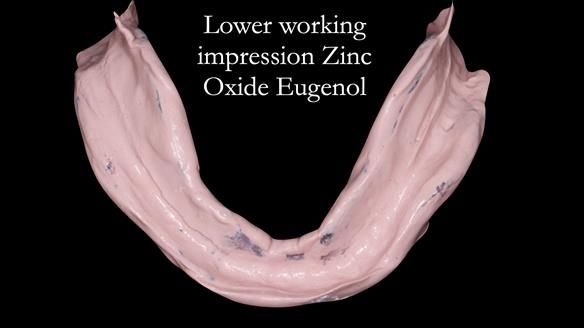 Finlay's Newsletter 62 provision of extractions and metal based complete dentures for Rafique