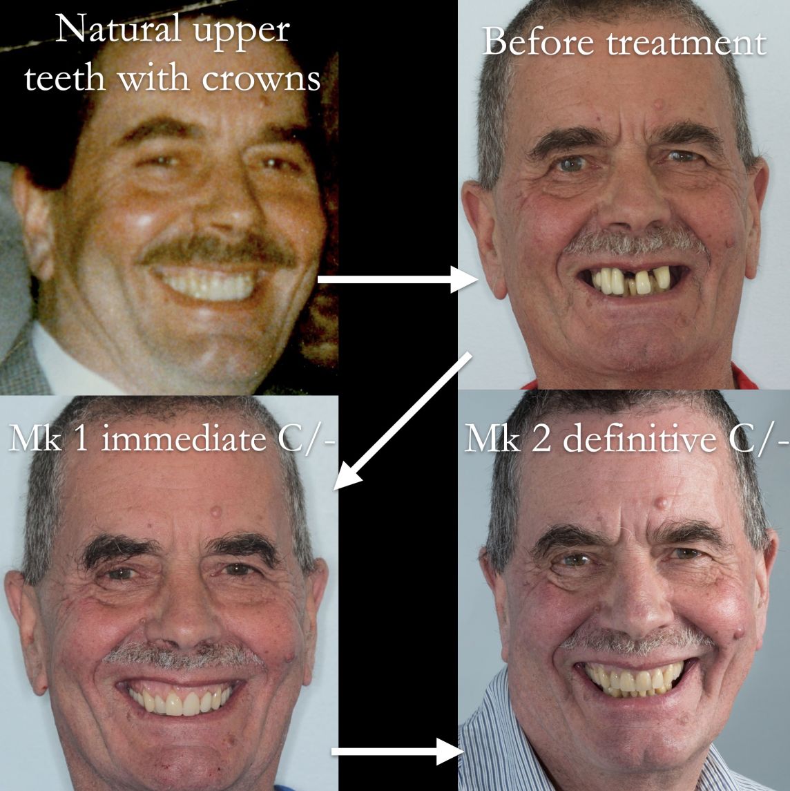 Immediate dentures are rarely definitive dentures