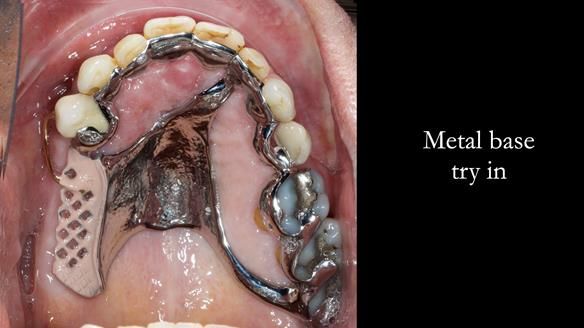 Finlay's Newsletter 64 case study - provision of a Kennedy class 2 metal based Scandinavian RPD for Ian