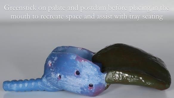 Newsletter 56 showing the making and fitting of a bilateral free end saddle upper removable partial denture (RPD) for patient with pemphigus