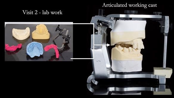 Finlay's Newsletter 64 case study - provision of a Kennedy class 2 metal based Scandinavian RPD for Ian