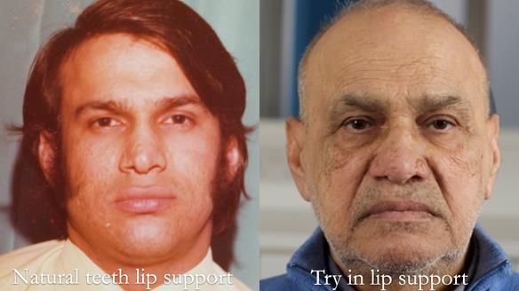 Managing poor implant positioning with complete dentures and Locator attachments - full protocol Newsletter 41